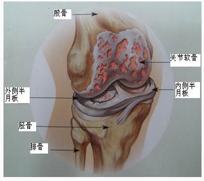 膝骨关节炎